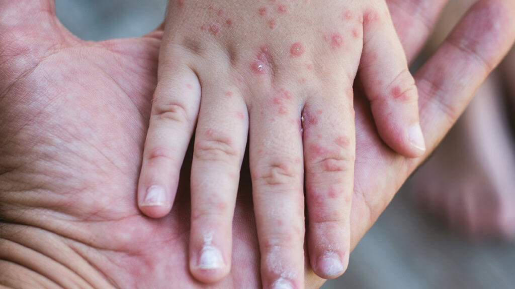 Over 1,400 measles contacts, 'invasive' strep cases up over 100% in Mississauga, Brampton and Caledon: report